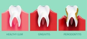 Teeth infographic. Gum disease stages, healthy gums, gingivitis, and periodontitis