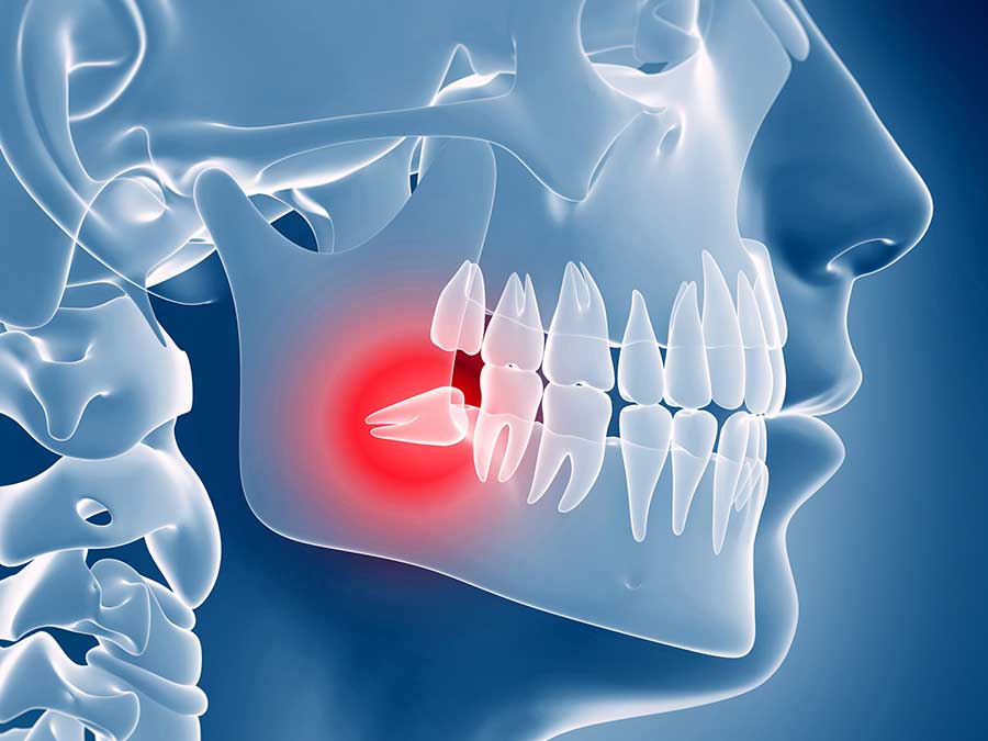 Intervention for Impacted Teeth